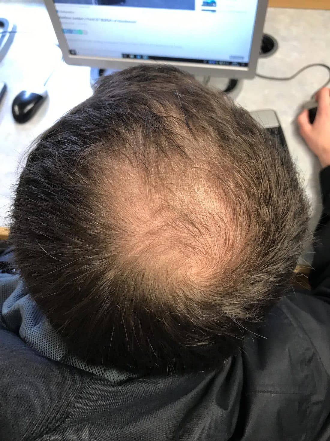 A man's scalp showing male-pattern hair loss with a receding hairline and thinning crown