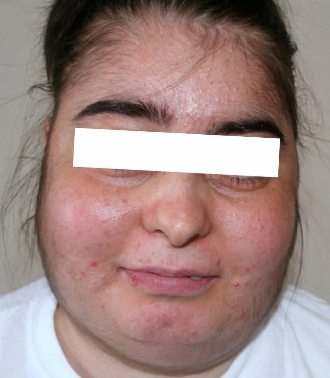 Clinical photo of the rounded, full 'moon face' caused by chronic cortisol excess in Cushing's syndrome