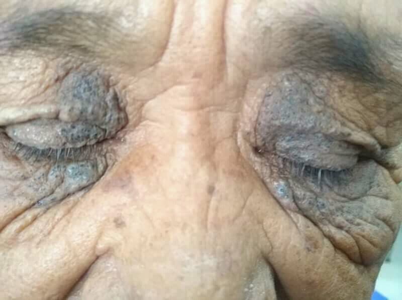 Favre-Racouchot syndrome: nodular solar elastosis with cysts and comedones around the eye from chronic sun damage.